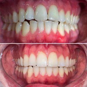 Invisalign sample image 1