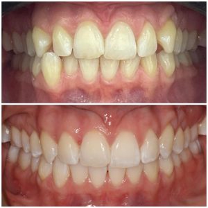 Invisalign sample image 2