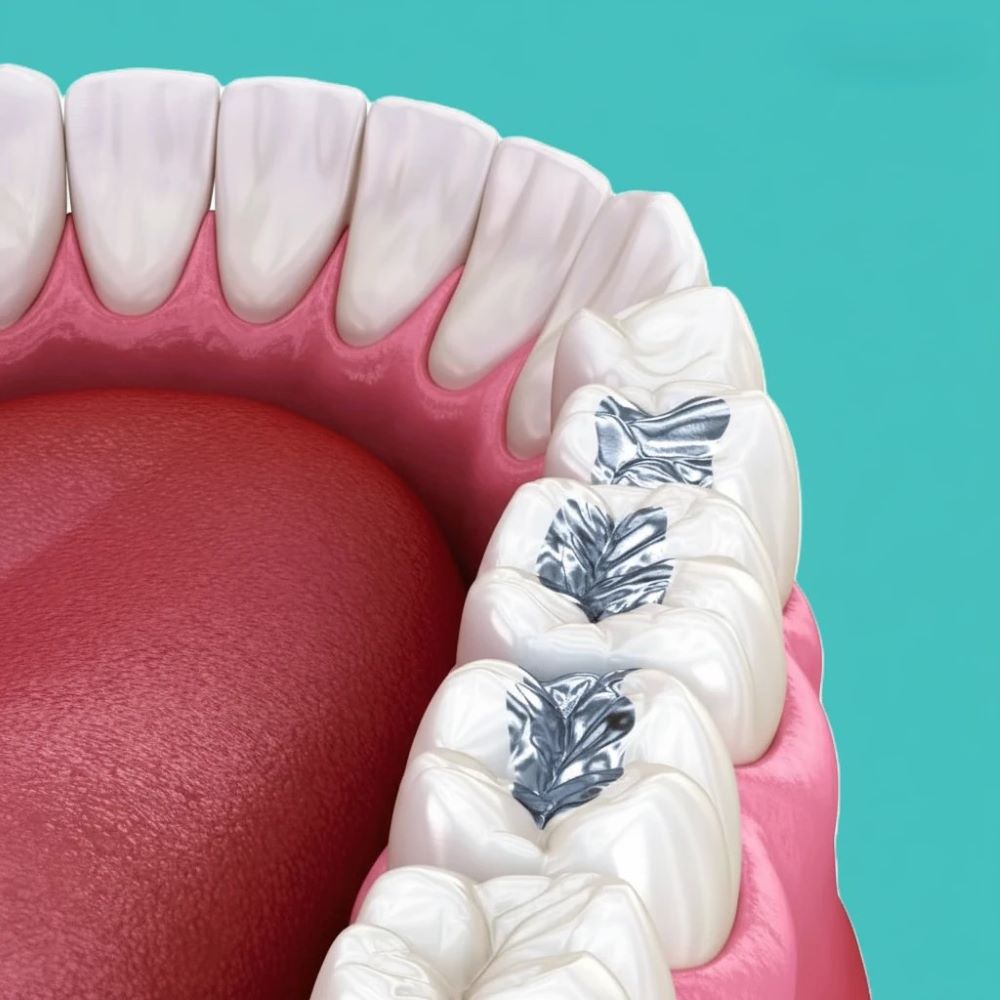 amalgam filling