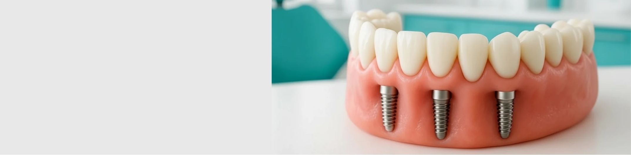 dental implants winchester