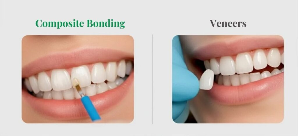 Composite bonding vs veneer in winchester