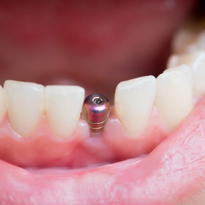 single teeth dental implant