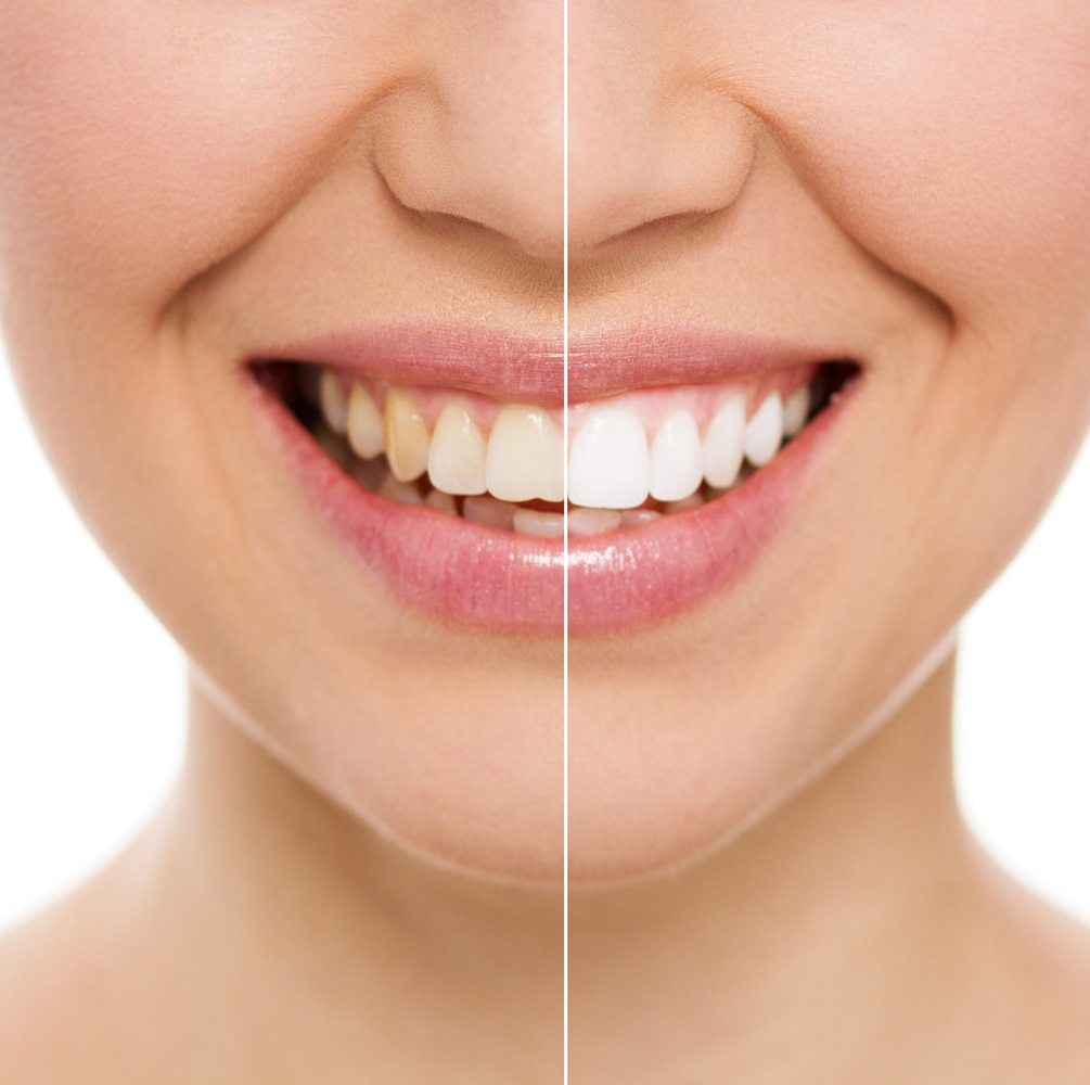 teeth whitening free included with invisalign