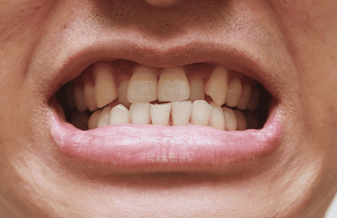 teeth anterior crossbite