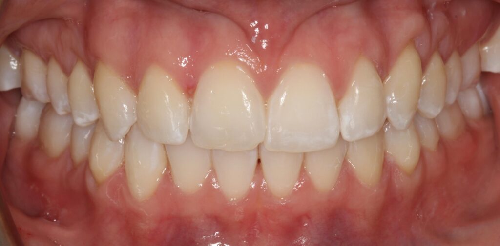 After treatment: Invisalign Aligners. Invisalign substantially straightened and levelled the upper and lower teeth, brought the displaced teeth into the arch, reduced crowding and produced a more balanced, coordinated bite and smile.. Oliver’s Battery Dental Surgery, Winchester