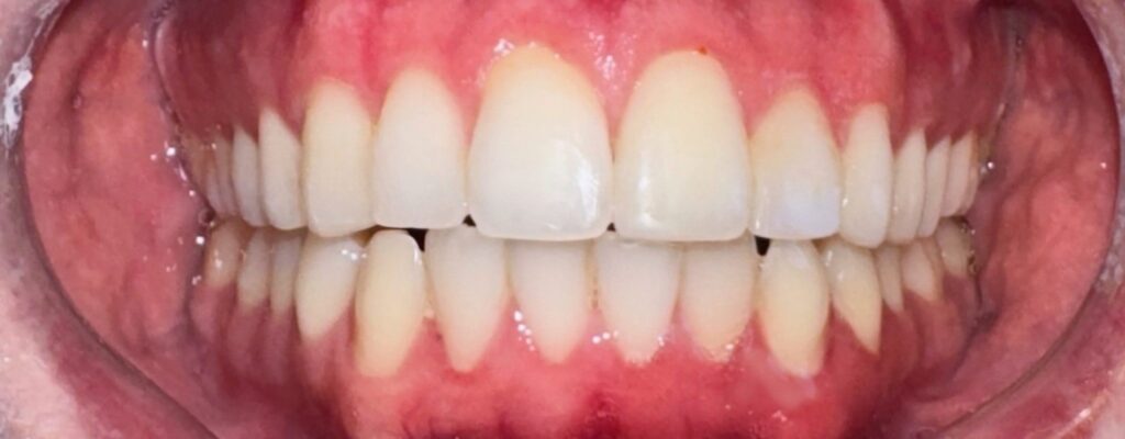 After treatment: Invisalign Aligners. Invisalign improved the alignment of both arches, reduced the anterior open bite and spacing, and created a more even, coordinated bite and balanced smile.. Oliver’s Battery Dental Surgery, Winchester
