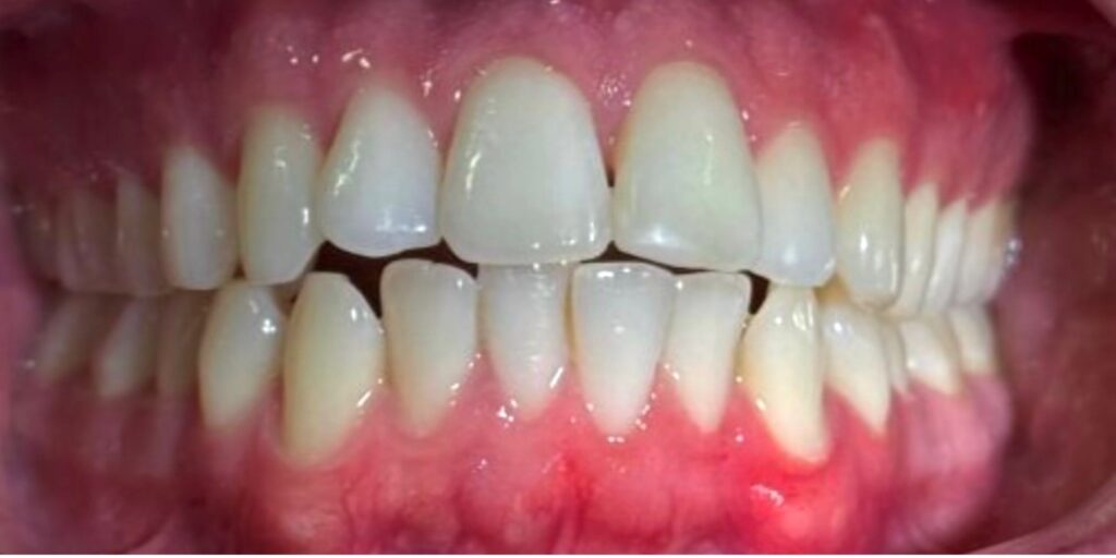 Before treatment: Invisalign Aligners. An anterior open bite with uneven alignment of the upper and lower front teeth, including spacing, rotations and lower-front crowding.. Oliver’s Battery Dental Surgery, Winchester