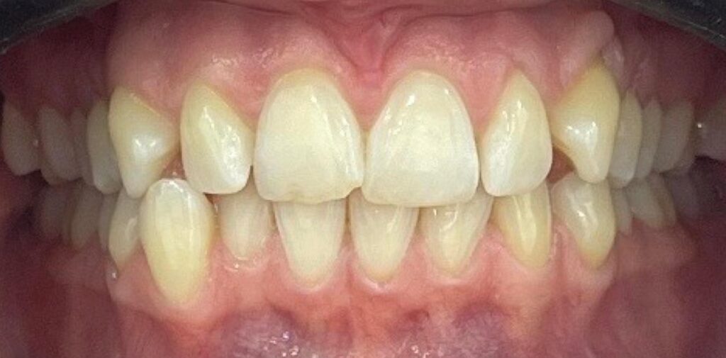 Before treatment: Invisalign Aligners. Significant crowding and rotations in both arches, with displaced upper lateral teeth/canines and overlapping lower front teeth, creating an uneven smile and bite.. Oliver’s Battery Dental Surgery, Winchester