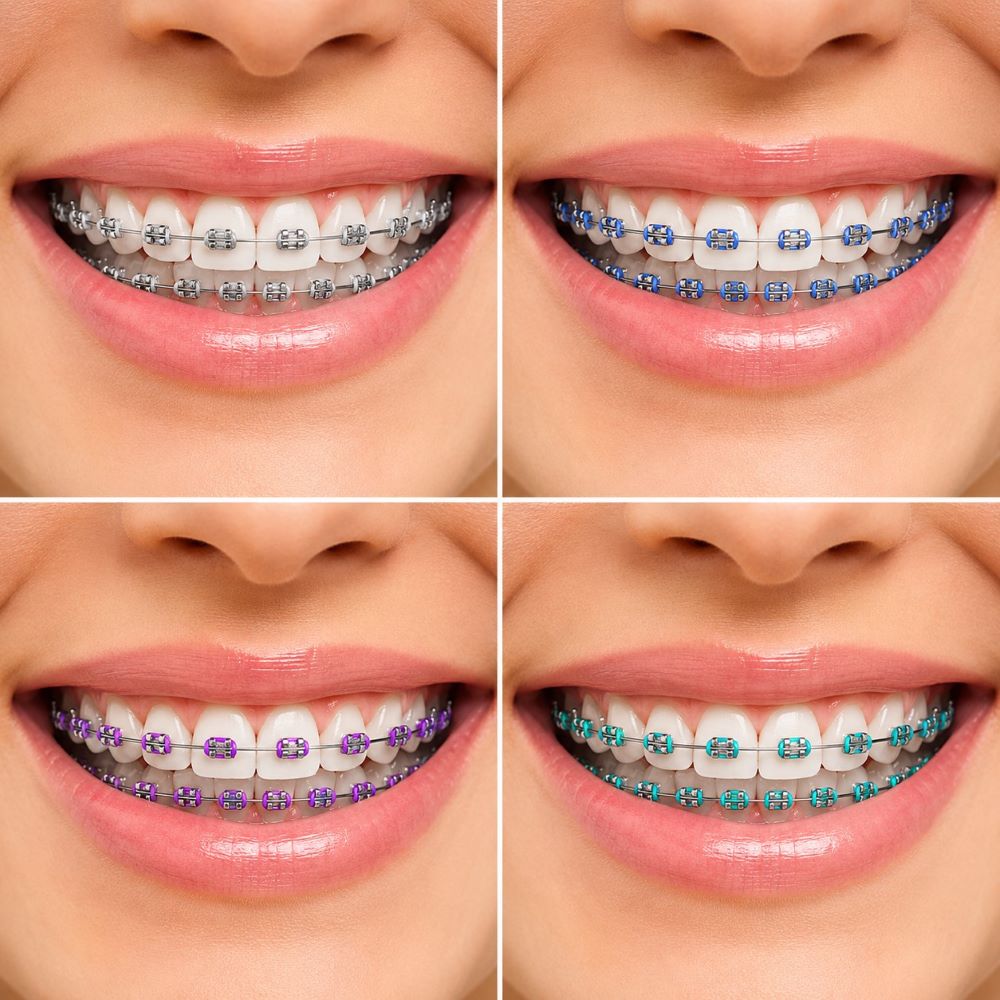 clear braces timeline clear braces multiple images showing the treatment time