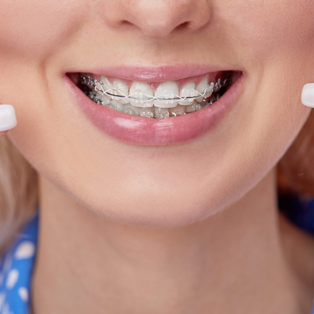 metal braces on a beautiflu smile