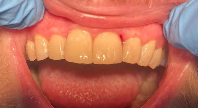 After treatment: Worn edges rebuilt and reshaped with composite . Smoother, more even front-tooth contours . Improved tooth length, proportions and overall smile balance. Oliver’s Battery Dental Surgery, Winchester