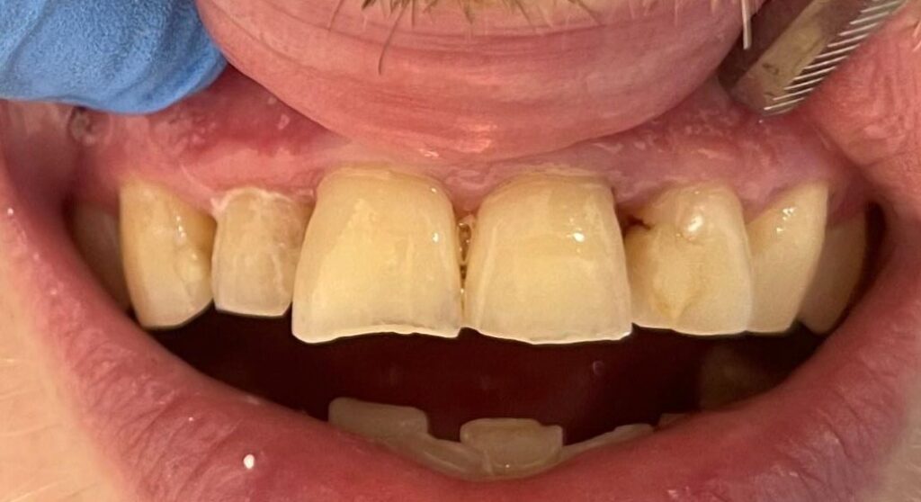 Before treatment: Visible wear across the upper front-tooth edges . Uneven and irregular incisal contours . Reduced tooth length affecting overall smile balance. Oliver’s Battery Dental Surgery, Winchester