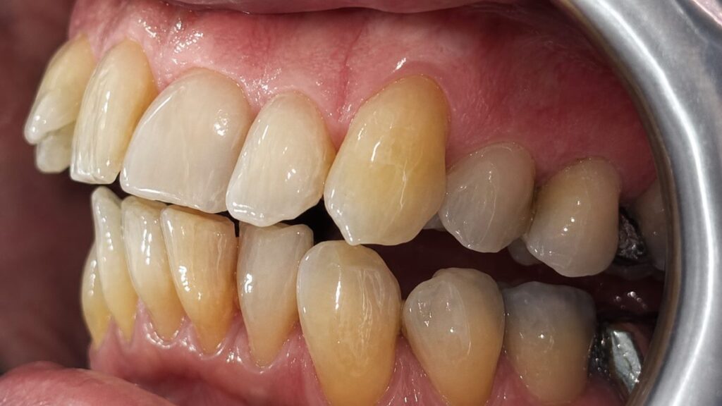 Before treatment: Visible crowding and irregular positioning in the upper and lower teeth . Prominent upper canine and uneven alignment through the side of the arch . Lower teeth appeared crowded and less well aligned overall. Oliver’s Battery Dental Surgery, Winchester