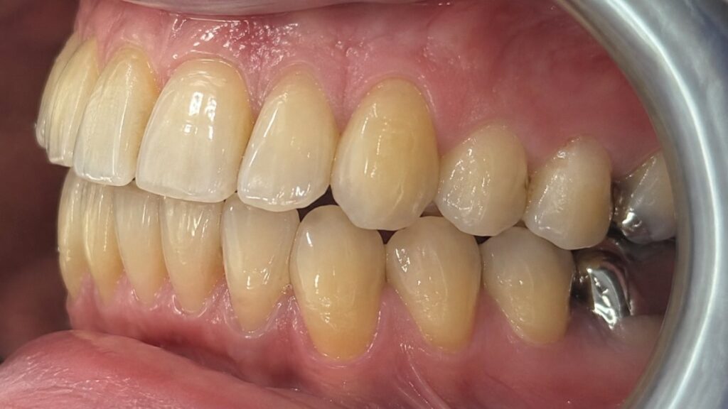 After treatment: Improved alignment of the upper and lower teeth . Upper canine and neighbouring teeth positioned more harmoniously within the arch . Straighter overall side profile with a more even and balanced appearance. Oliver’s Battery Dental Surgery, Winchester