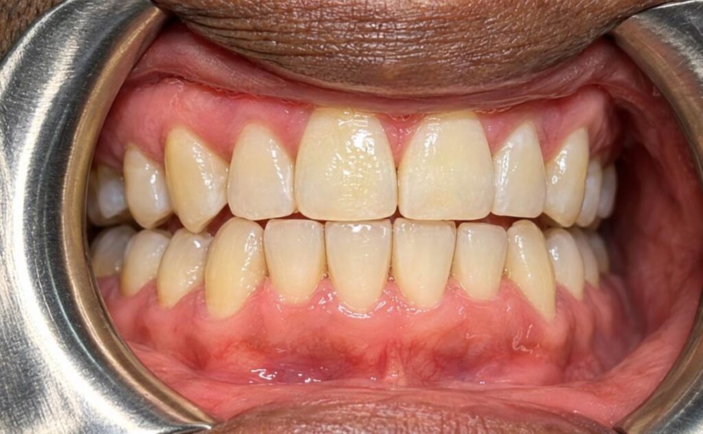 Upper central-incisor gap closed with more even front-tooth alignment after Invisalign