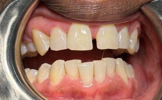 Gap between the upper central incisors and uneven lower front-tooth alignment before Invisalign