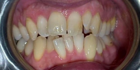 Marked upper and lower front-tooth crowding with overlapping and displaced teeth before Invisalign