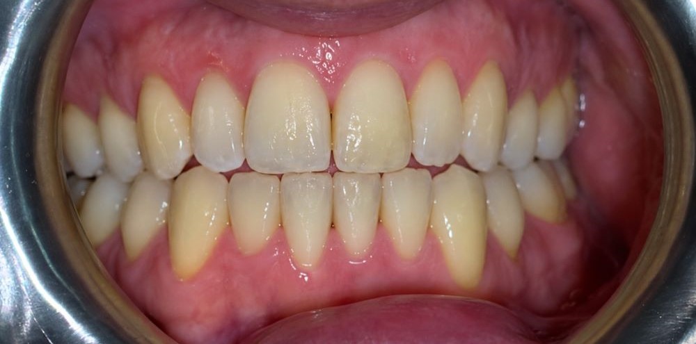 More evenly aligned upper and lower front teeth with reduced crowding after Invisalign